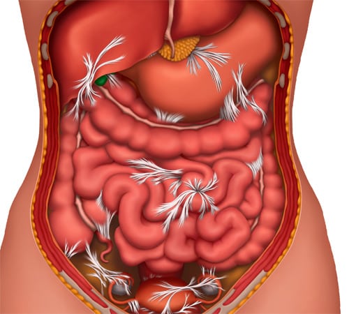 Bowel Obstruction